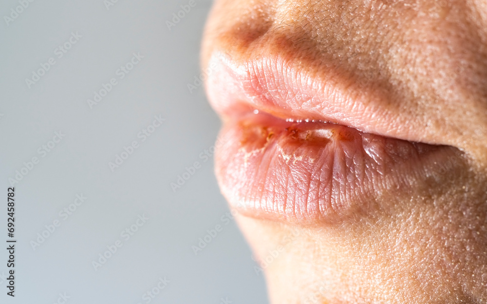 © Сергей Дудиков - Women's lips after high body temperature, lips cracked with blood. Dry lips. © Сергей Дудиков - Women's lips after high body temperature, lips cracked with blood. Dry lips.
