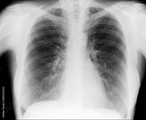 Human Chest X-ray image, orthogonal projection for a medical diagnosis.