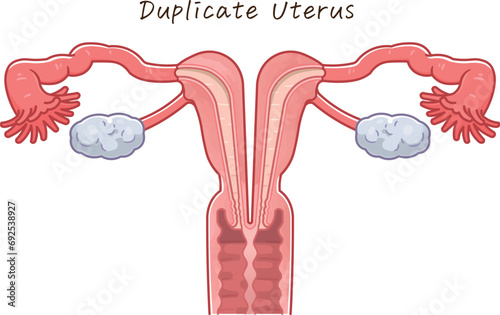 子宮奇形・Uterine malformation