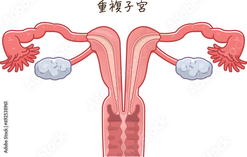 子宮奇形・Uterine malformation