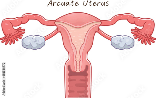 子宮奇形・Uterine malformation