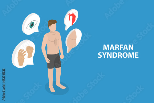 3D Isometric Flat Vector Illustration of Marfan Syndrome, Dwarfism