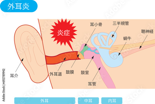 外耳炎の構造図
