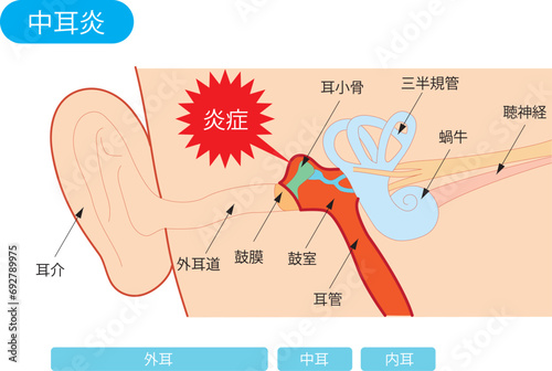 中耳炎の構造図
