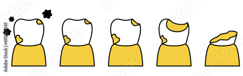 虫歯の進行イメージイラスト、シンプルな線画