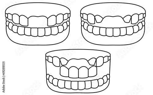 Illustration of a bridge over a missing front tooth, simple line drawing