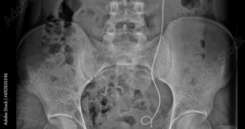 detailed X-Ray of the Kidneys, Ureters, and Bladder (KUB) featuring a prominently placed DJ stent. This high-resolution footage offers a rare insight into the realm of urinary system intervention.