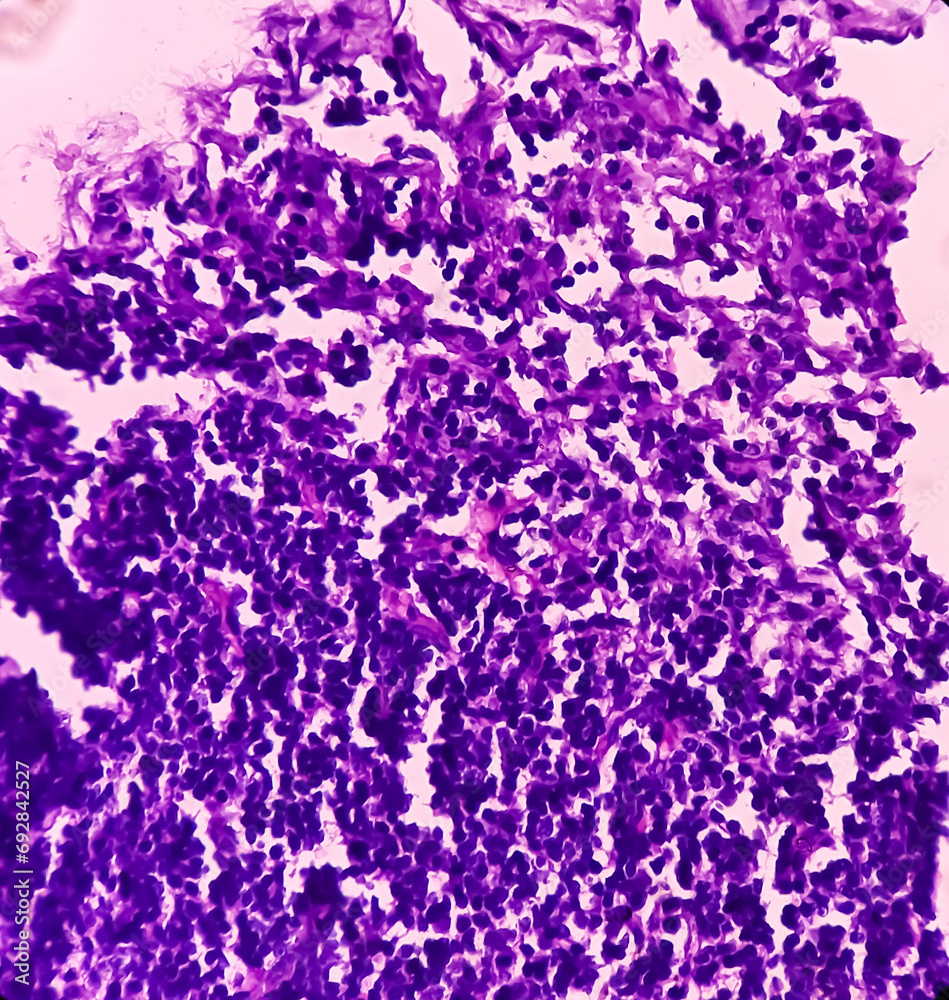 Thyroid cancer. Tracheal gland involved by tumor. Microscopic image of ...