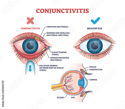 Conjunctivitis pink eye medical condition explanation outline diagram. Labeled educational scheme with healthy lens comparison with virus or bacterial infection and inflammation vector illustration.