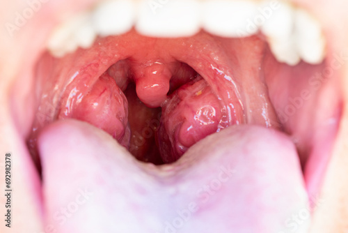 The child is a patient with large red glands. Tonsils in close-up in the mouth. Closeup view of open mouth with tonsils photo