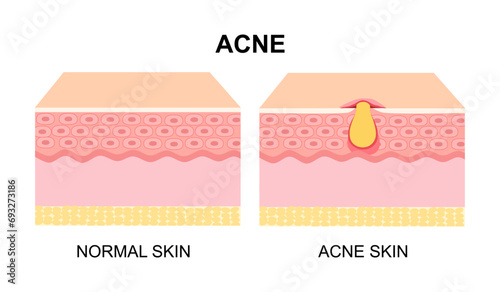 Difference of Normal skin layer and skin layer with Acne. Illustration about dermatology diagram.
