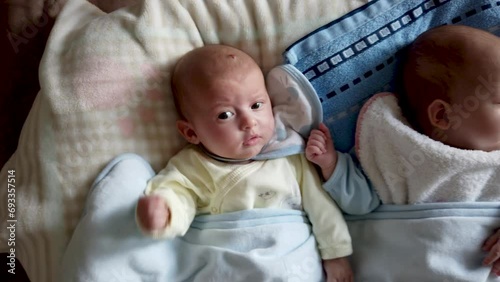 Two baby twins lie on the bed, one hase hemangioma on its head photo