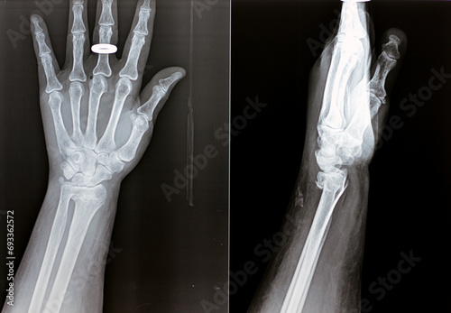 Colles' fracture of an old female, a type of fracture of the distal forearm in which the broken end of the radius is bent backwards, as a result of a fall on an outstretched hand with osteoporosis photo