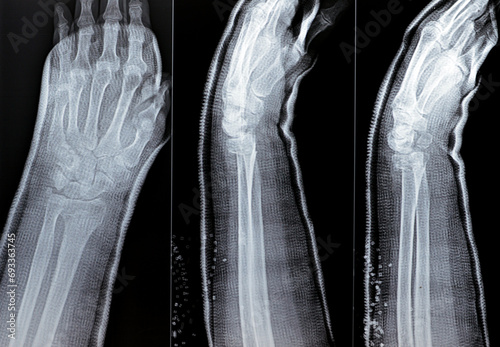 Colles fracture reduction of an old female, a type of fracture of the distal forearm, the broken end of the radius is bent backwards, as a result of a fall on an outstretched hand with osteoporosis photo