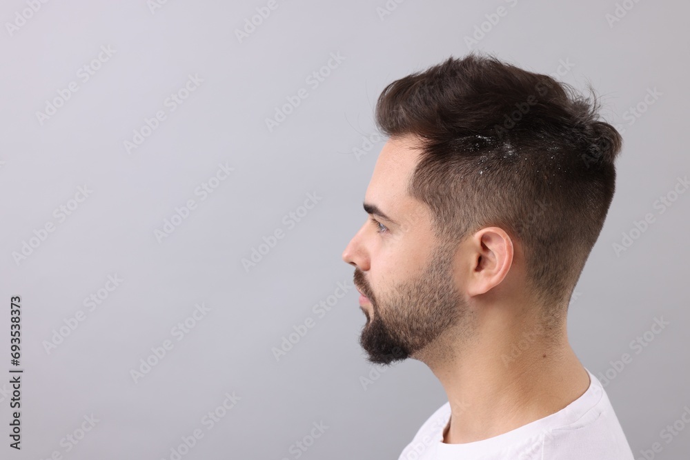 Man with dandruff in his dark hair on light grey background, space for text Man with dandruff in his dark hair on light grey background, space for text