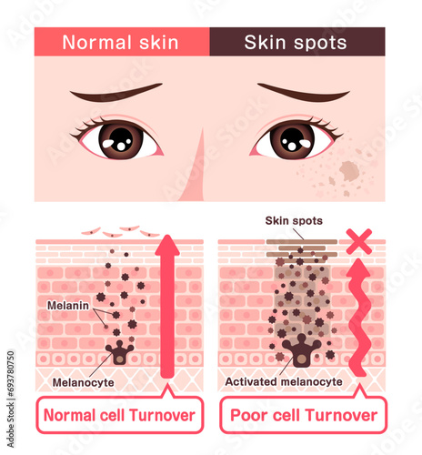 Vector illustration of how skin spots (hyperpigmentation) are created.