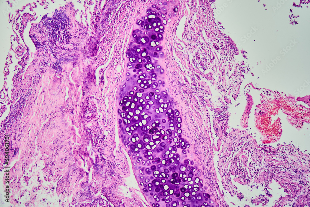 Tableau sur toile Medical themes: Transbronchial lung byopsia of Cryptogenic Organizing Pneumonia