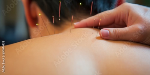 Acupuncture Therapy Practice on Back