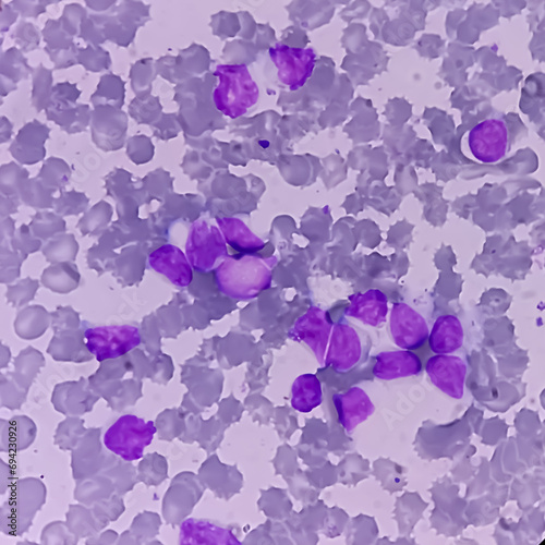 Leukemia. blood cells, blast cells and immature leukocytic cells in chronic lymphocytic leukemia, prolymphocytic leukemia, acute lymphoblastic leukemia.