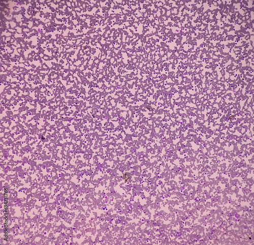 Leukemia. blood cells, blast cells and immature leukocytic cells in chronic lymphocytic leukemia, prolymphocytic leukemia, acute lymphoblastic leukemia. photo