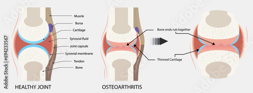 Rheumatoid arthritis, osteoarthritis of the joint. Images of healthy and diseased joints with main parts labeled, isolated on white, Vector, illustration, comparison, healthy joint, and arthritis.