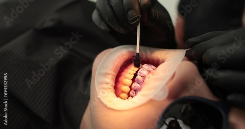Health dental care. Professional teeth cleaning. A dentist performs a preventive deep cleaning procedure for a patient in the dental office. Ultrasonic teeth cleaning. Oral hygiene. photo