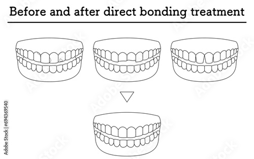 Cosmetic dentistry: treatment with direct bonding, decayed or chipped teeth, and gaps