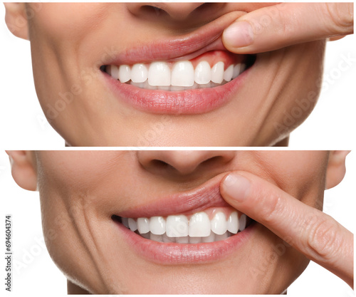 Woman showing gum before and after treatment on white background  collage of photos