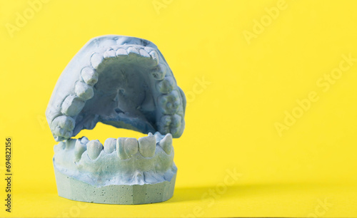 Blue plaster impression of a patient's dental jaw with crooked teeth and malocclusions on a yellow background. Manufacturing of bridges, crowns of various types, macro. photo