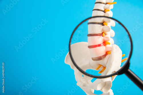 Model of the lumbar spine with a red intervertebral hernia and protrusion on a blue background under a magnifying glass. Concept of osteochodrosis and spondyloarthrosis  photo