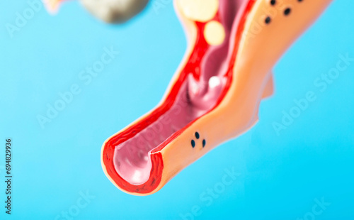 Mockup of the female reproductive system of the vagina on a blue background. Concept of diseases and infections of the vagina, chlamydia and ureaplasmosis, bacterial vaginosis. Maintaining hygiene  photo