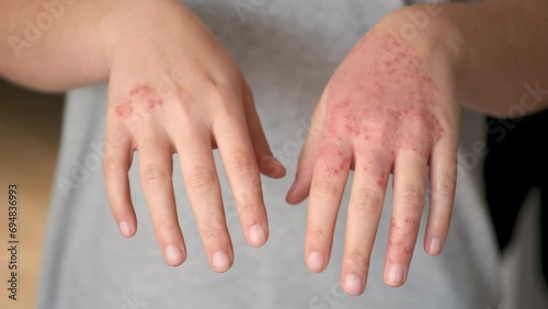 Unrecognizable woman with eczema on hands, atopic dermatitis concept. photo