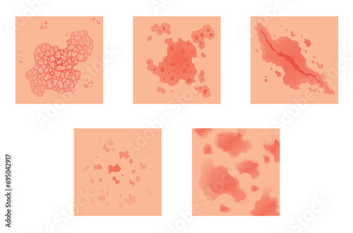 Different types of psoriasis vector set. Part of patients skin with dermatitis, inflammation, red rash and other skin problems. Cartoon illustration for disease concept