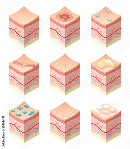 Skincare medical concept. Set of problems of different skin types in cross-section of human skin horizontal layers structure. Anatomy illustrative model layers of skin