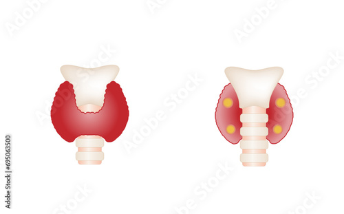 Thyroid and parathyroid gland. Anatomy front and back view of thyroid gland. hypothyroidism vs hyperthyroidism. Vector illustration isolated on white background.