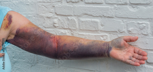 Hämatom Bluterguss am ganzen Arm durch ein Ellenbogenbruch
 photo