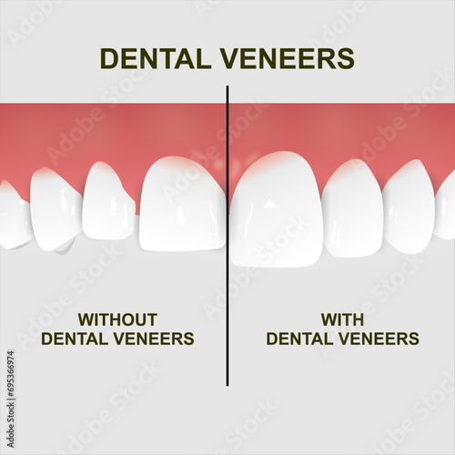 Dental Veneers Illustration Tooth Straightened Demo 