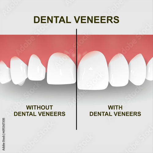 Dental Veneers Illustration Tooth Straightened Demo 