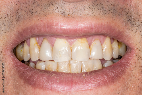 Frontal view of a smiling man, dental maxillary and mandibular arches with yellowish teeth with a poor quality of dental enamel colored because of smoking cigarettes and bad hygiene