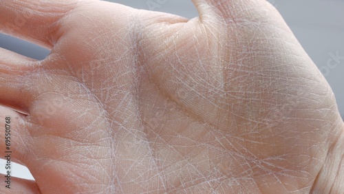 Dry skin on palm close-up side view peeling skin on palm lack of moisture dermatitis cosmetology and dermatology healthcare and medicine hand care, concept of problematic dry skin on palms of hands photo