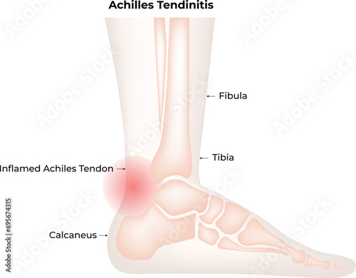 Achilles Tendinitis Science Design Vector Illustration