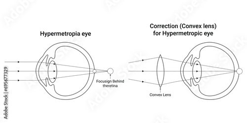 Hypermetropia eye Science Design Vector Illustration Diagram