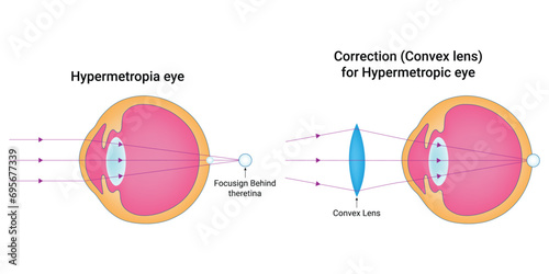 Hypermetropia eye Science Design Vector Illustration Diagram