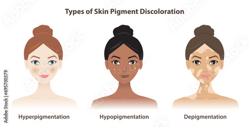 Types of skin pigment discoloration vector isolated on white background. Hyperpigmentation, darkened pigment. Hypopigmentation, lightened pigment. Depigmentation, loss of pigment.