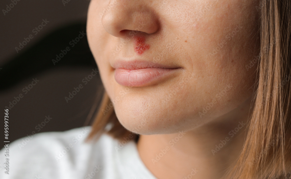 Foto de Close up woman's hand touches inflamed sores with blisters from