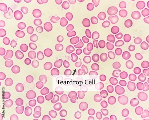 Teardrop cells (dacrocytes) are frequently associated with infiltration of the bone marrow by fibrosis, granulomatous inflammation, hematopoietic or metastatic neoplasms. photo