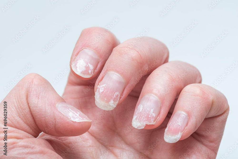 Flaky bitten and brittle nails without a manicure. Regrown nail cuticle and damaged nail plate after gel polish - obrazy, fototapety, plakaty 