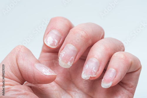 Flaky bitten and brittle nails without a manicure. Regrown nail cuticle and damaged nail plate after gel polish photo