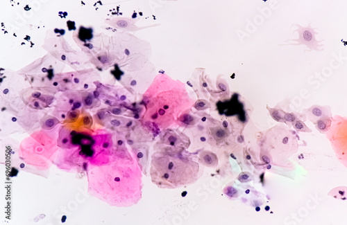 Photomicrograph of Paps smear: Inflammatory smear with HPV related changes. Cervical cancer. SCC photo