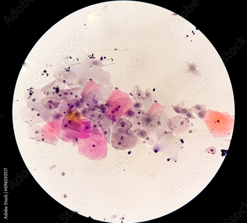 Photomicrograph of Paps smear: Inflammatory smear with HPV related changes. Cervical cancer. SCC